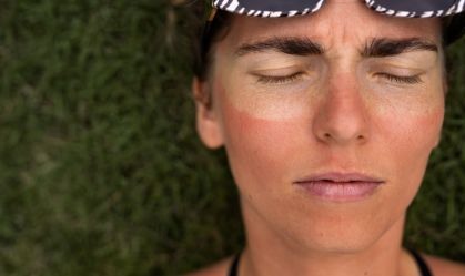 Queimadura de sol? Dermatologista explica quais produtos ajudam a salvar sua pele